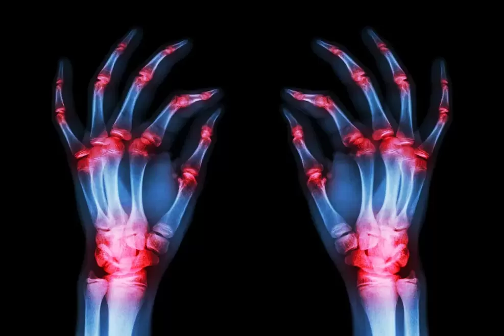 Artrose das articulacións dos dedos