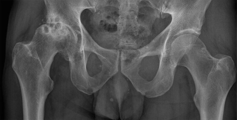 Artrose en fase 3 da articulación da cadeira na radiografía