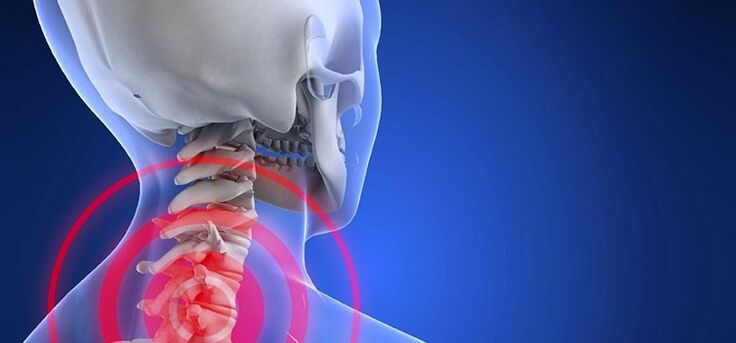 Osteocondrose da rexión do cérvix