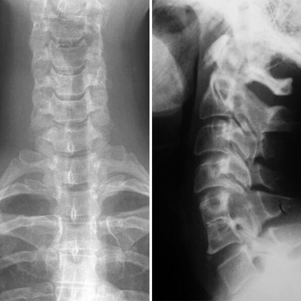 X -ray a columna cervical