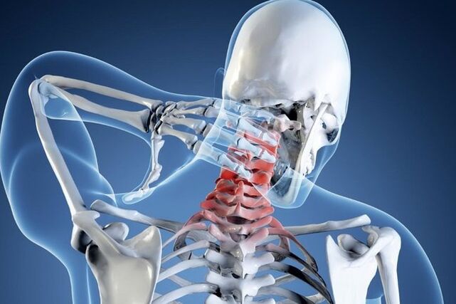 Osteocondrose da rexión do cérvix