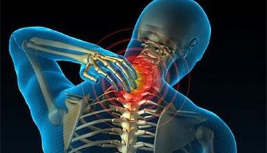 Síntomas da osteocondrose da columna cervical
