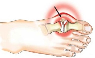 Inflamación da articulación entre o polgar e o pé na artrite