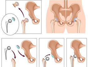 Endopróteses para a artrose da articulación da cadeira