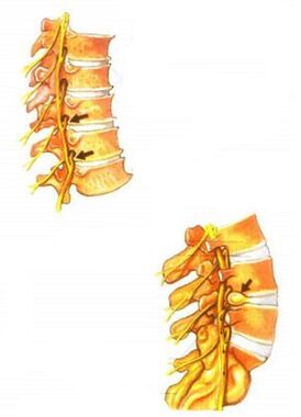 Ilustración de osteocondrose da columna vertebral