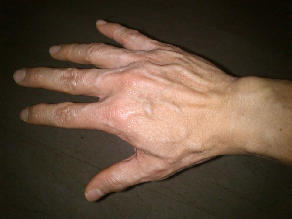 Deformación ósea e dor nas articulacións dos dedos