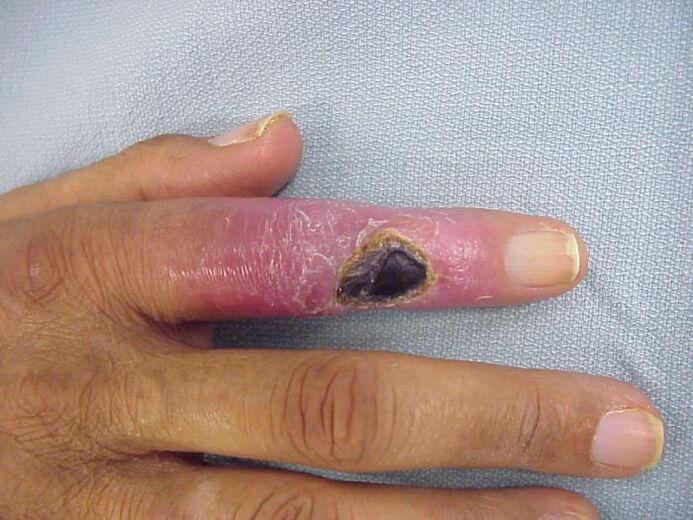 Osteomielite como causa de dor nas articulacións dos dedos