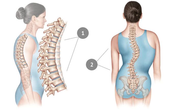 Curvatura espinal como causa de osteocondrose torácica